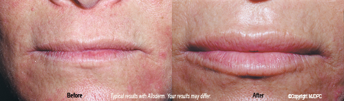 wrinkle_fillers1