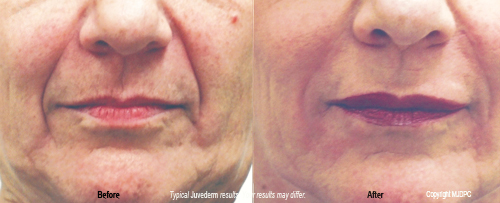 wrinkle_fillers2
