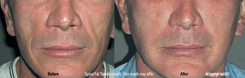 wrinkle_fillers3